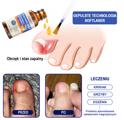 🐝🐝 Bienengift Nailpilz Treatment: Complete solution to the problem of nail fungus🌟👣